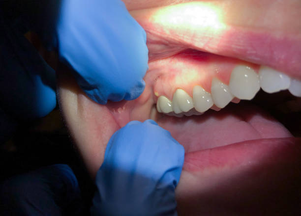 Best Knocked-Out Tooth (Avulsed Tooth) Treatment in Fairhope, AL